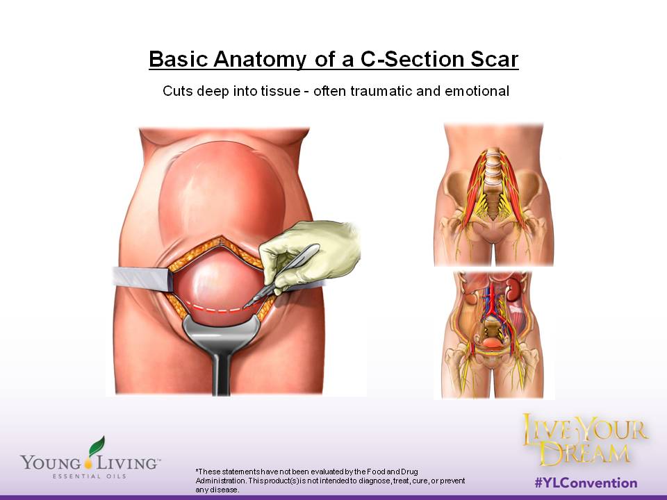 The Basic Anatomy of a C-Section Scar 